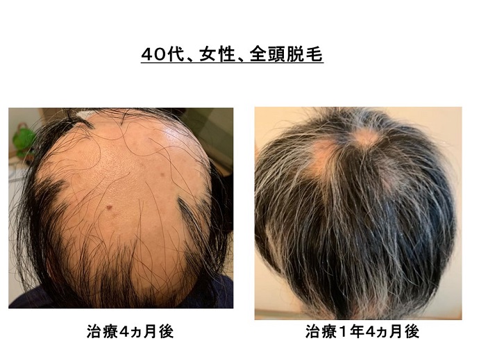 円形脱毛症　病院